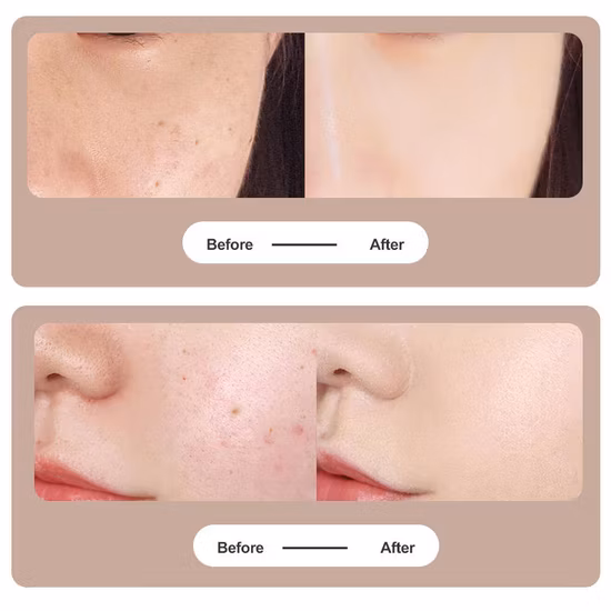 Penna per rimozione macchie di talpe con penna al plasma di bellezza